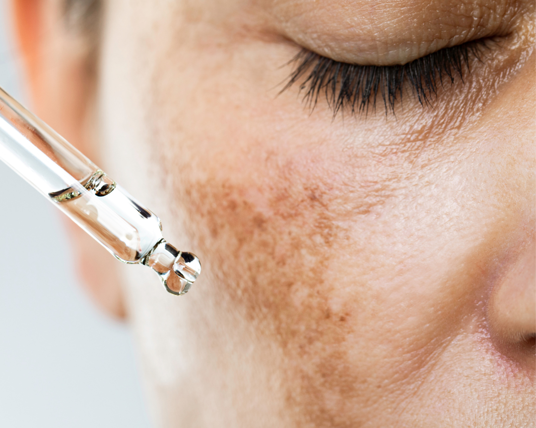  Melasma Month