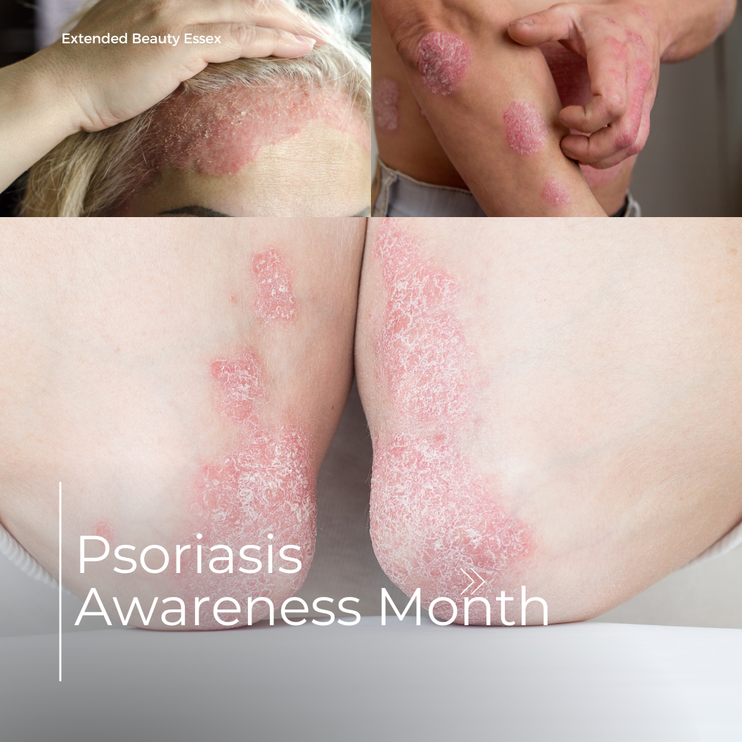 Hyperpgmentation Month Hyperpigmentation / Melasma Month – EssentailBeautyEssex