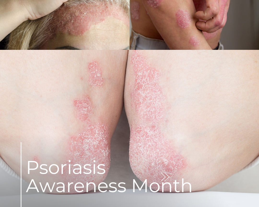 Empowering Lives: Shedding Light on Psoriasis During Awareness Month