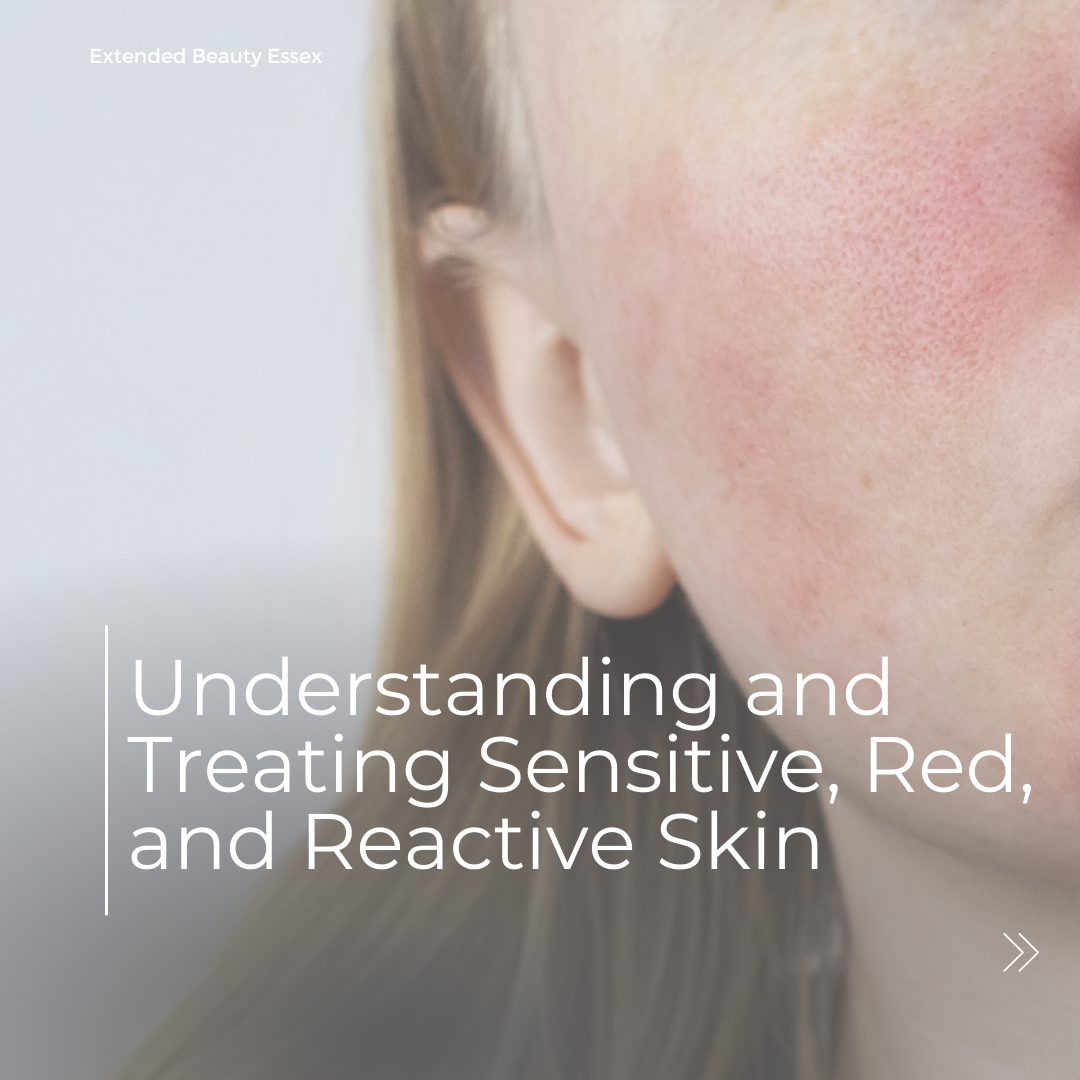 Rosacea Awareness Month: Understanding and Treating Sensitive, Red, and Reactive Skin