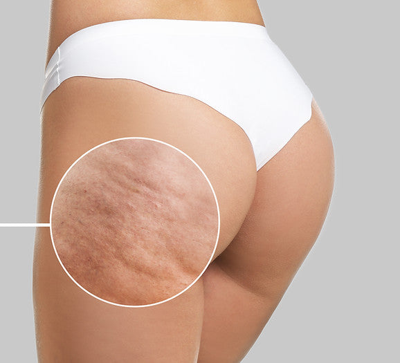 Collagen Lift for Cellulite